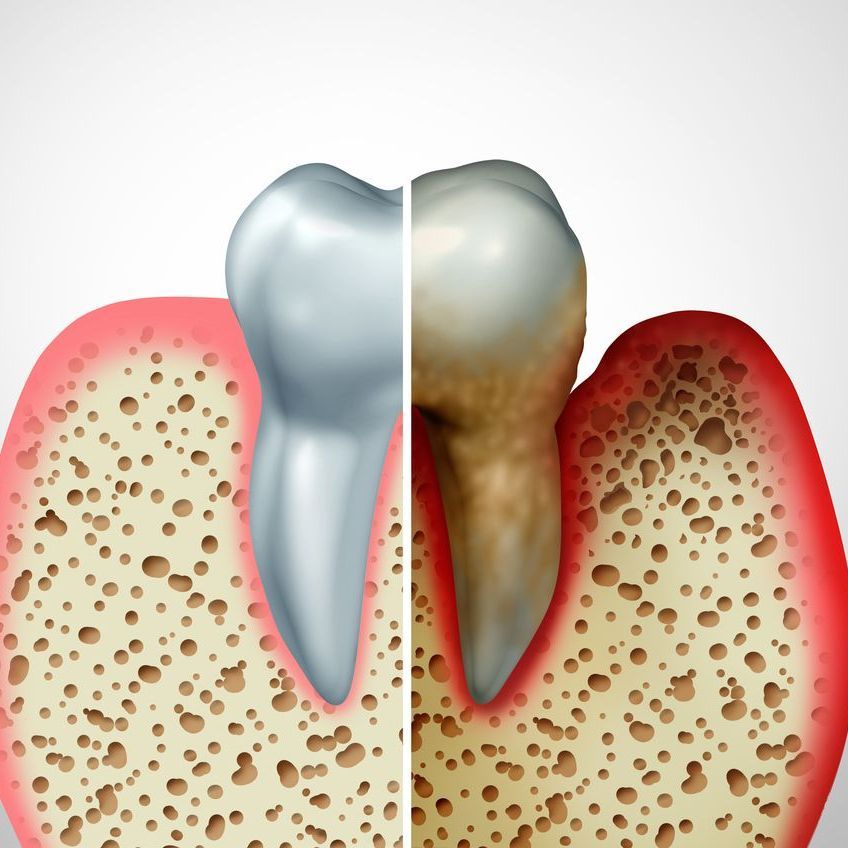 A tooth is shown before and after being removed