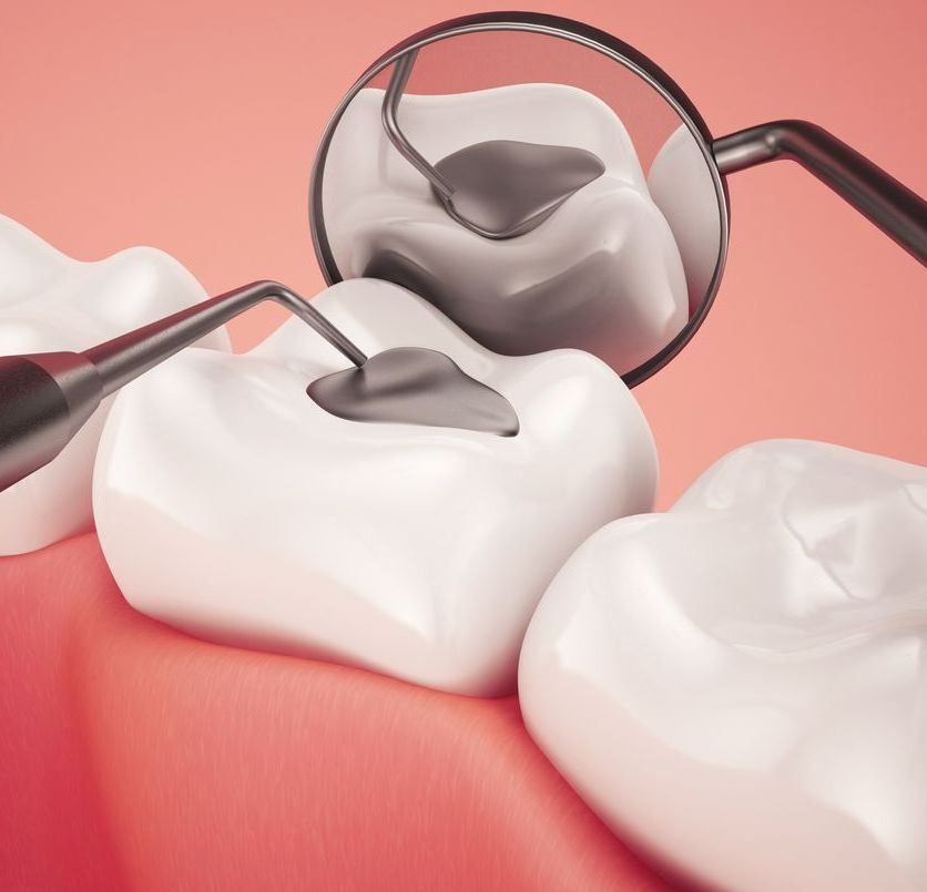 A close up of a tooth being examined by a dentist