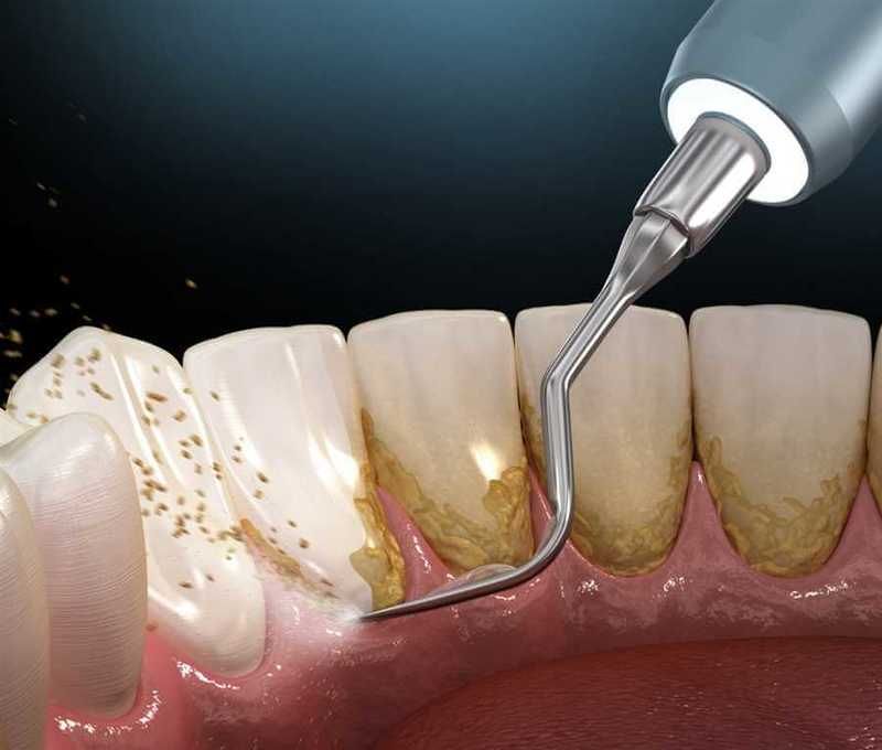 Removing plaque from teeth