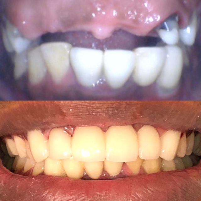 Smile Makeover Before & Afters