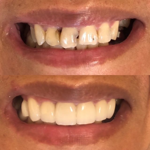 Smile Makeover Before & Afters