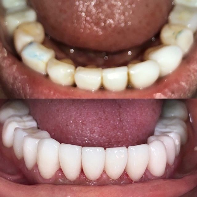 Smile Makeover Before & Afters