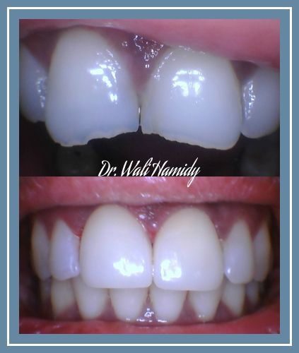 Smile Makeover Before & Afters