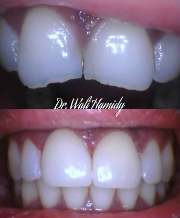 A before and after photo of a person 's teeth by dr. wali hamidy