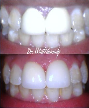 A before and after photo of a person 's teeth by dr. walihamidy
