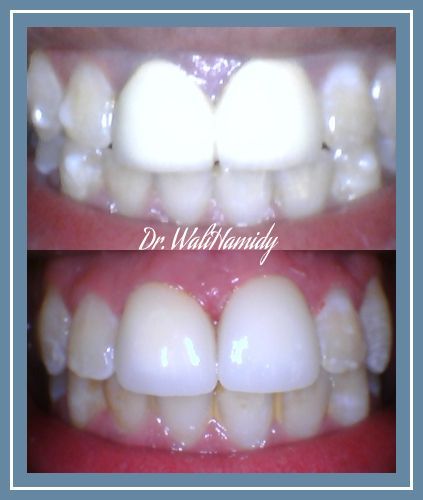 Smile Makeover Before & Afters