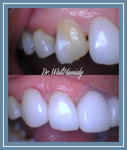 Smile Makeover Before & Afters