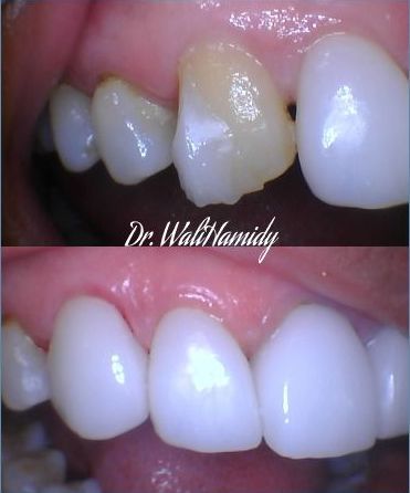 A before and after photo of a person 's teeth by dr. walihamidy