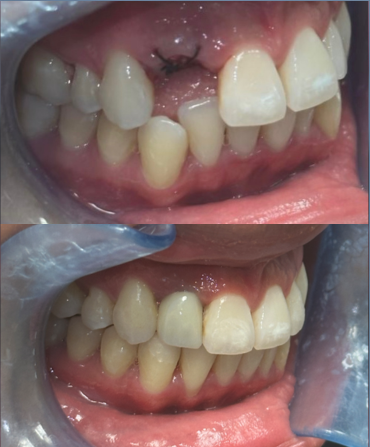 A before and after picture of a person 's teeth