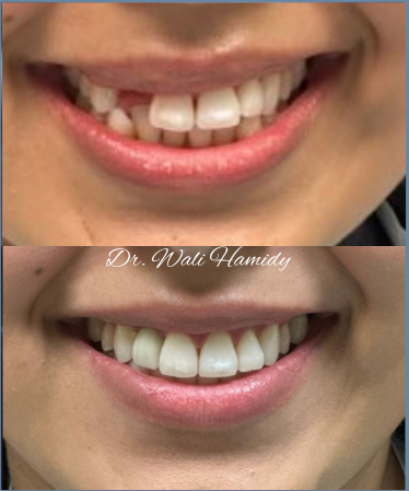 A before and after picture of a person 's teeth.