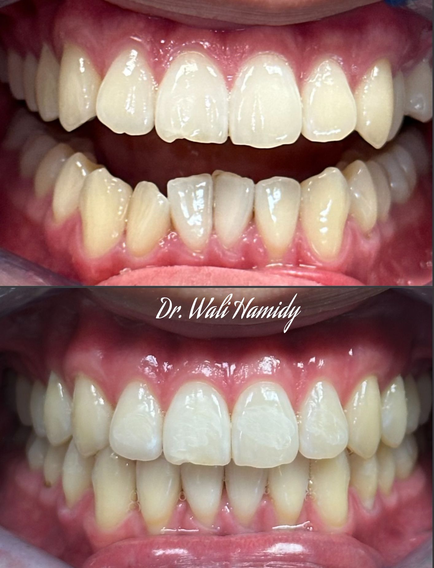 dental implants Before & Afters