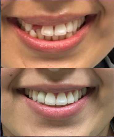 A before and after picture of a person 's teeth.