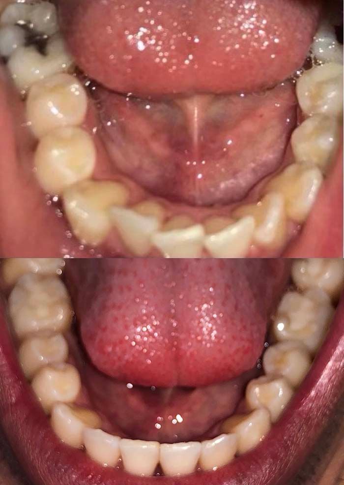 Invisalign Before & Afters