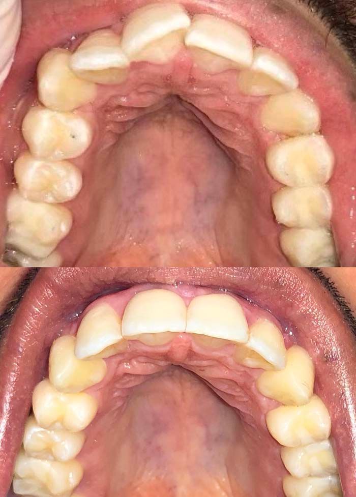 Invisalign Before & Afters