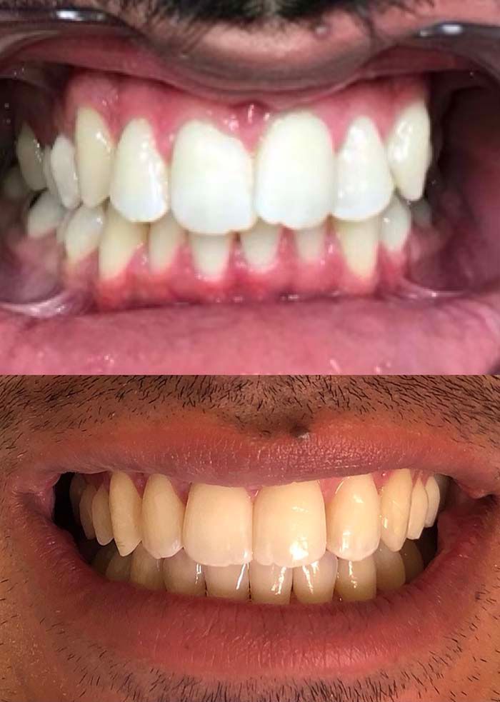 Invisalign Before & Afters