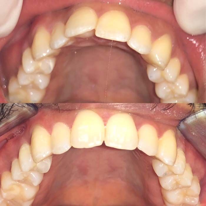 Invisalign Before & Afters