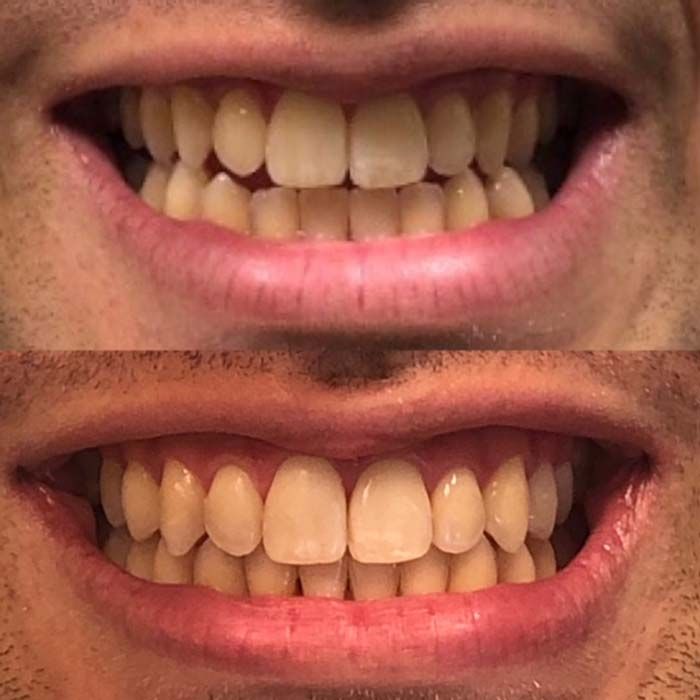 Invisalign Before & Afters