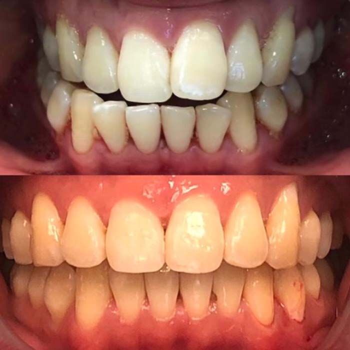 Invisalign Before & Afters