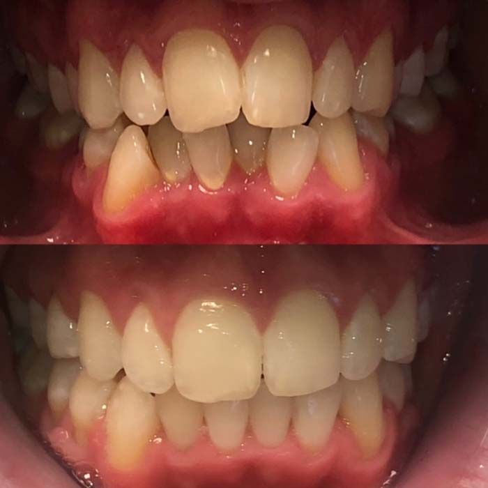 Invisalign Before & Afters