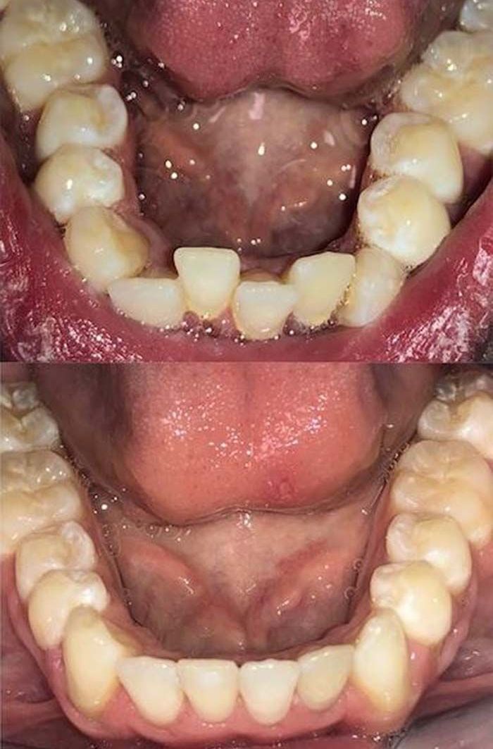 Invisalign Before & Afters