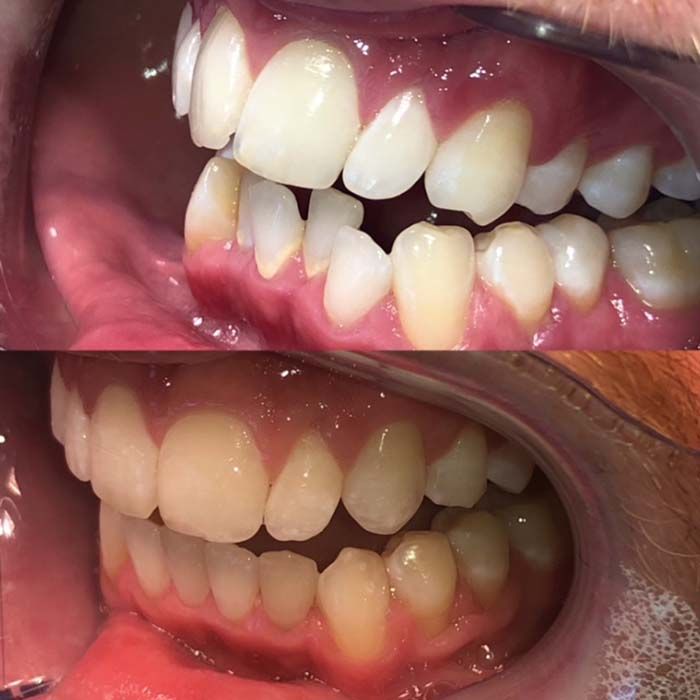 Invisalign Before & Afters