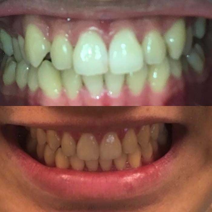 Invisalign Before & Afters