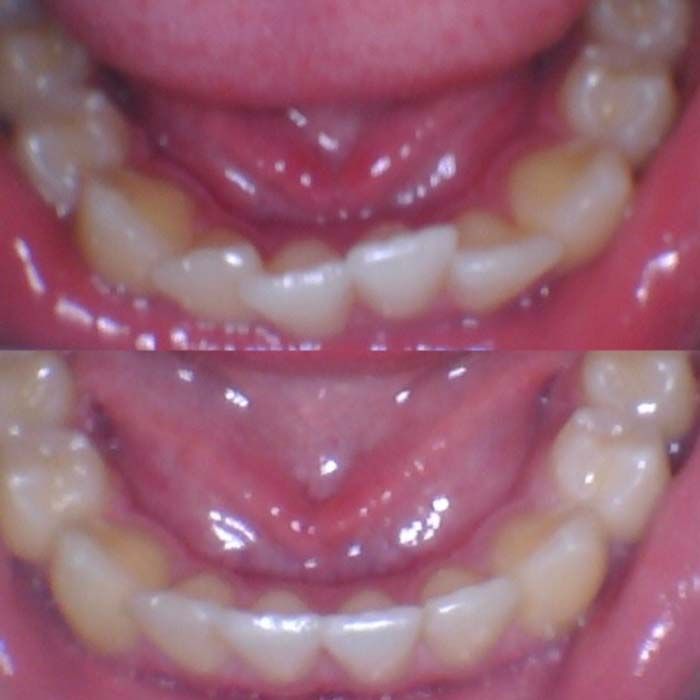 Invisalign Before & Afters