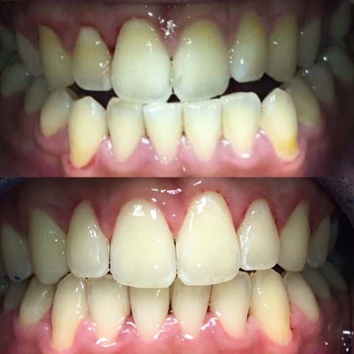 Invisalign Before & Afters