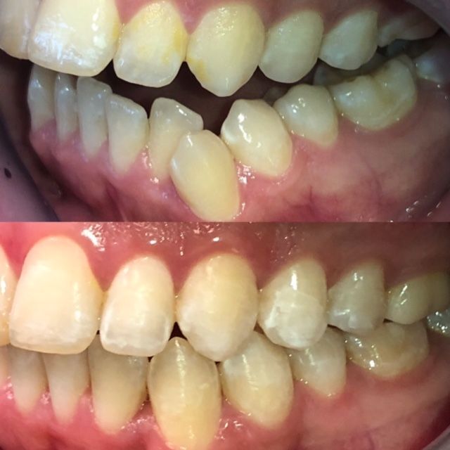 Invisalign Before & Afters