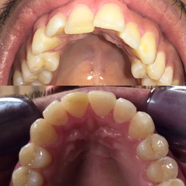 Invisalign Before & Afters