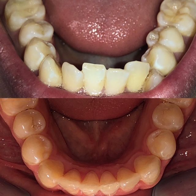 Invisalign Before & Afters