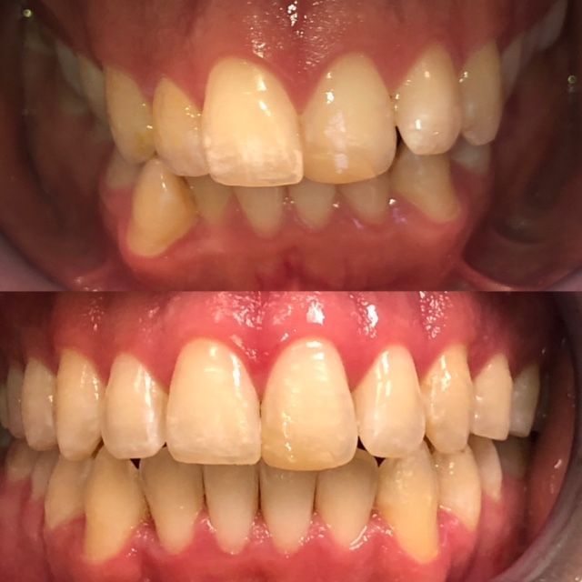 Invisalign Before & Afters