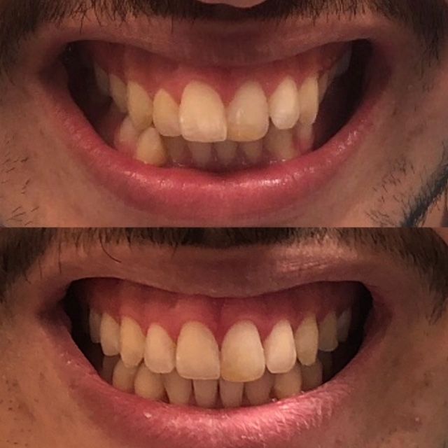 Invisalign Before & Afters