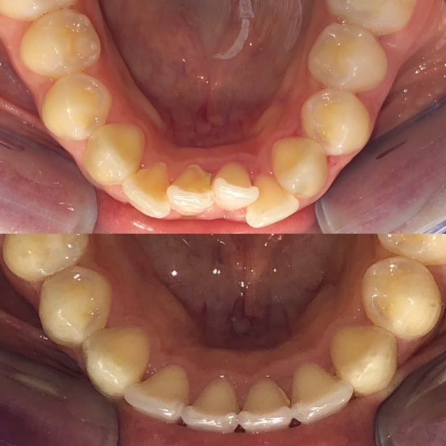 Invisalign Before & Afters