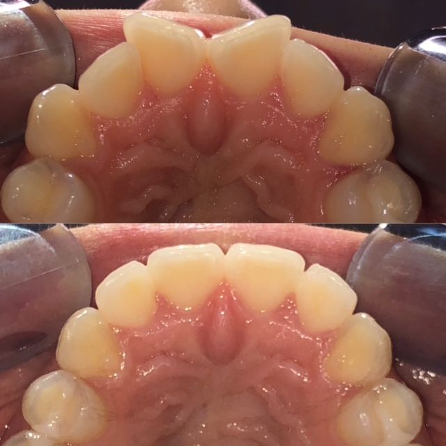 Invisalign Before & Afters