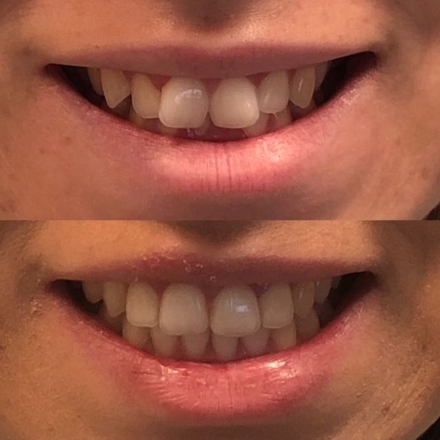 Invisalign Before & Afters