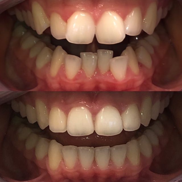 Invisalign Before & Afters