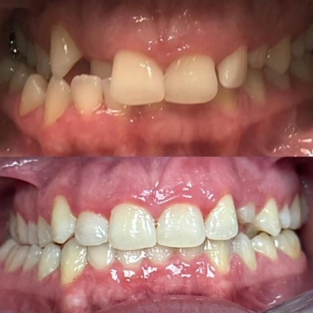 Invisalign Before & Afters