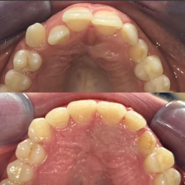 Invisalign Before & Afters