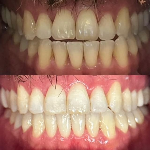 Invisalign Before & Afters