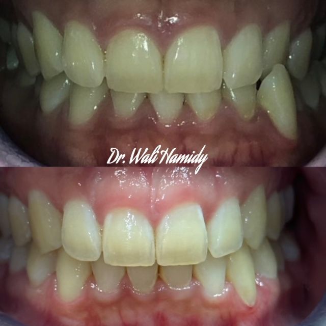 Invisalign Before & Afters