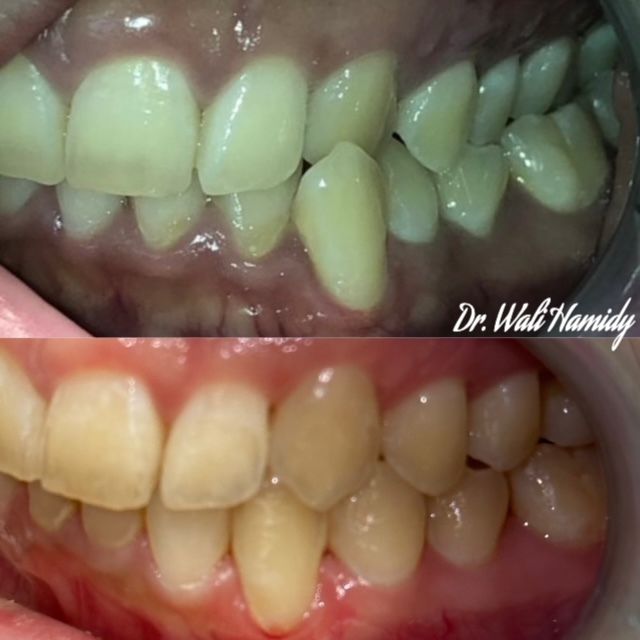 Invisalign Before & Afters