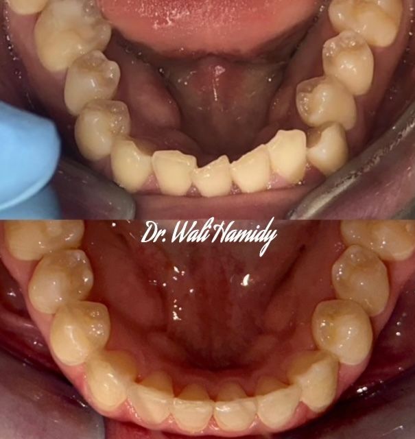 Invisalign Before & Afters