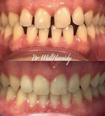 Invisalign Before & Afters