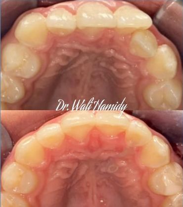 Invisalign Before & Afters