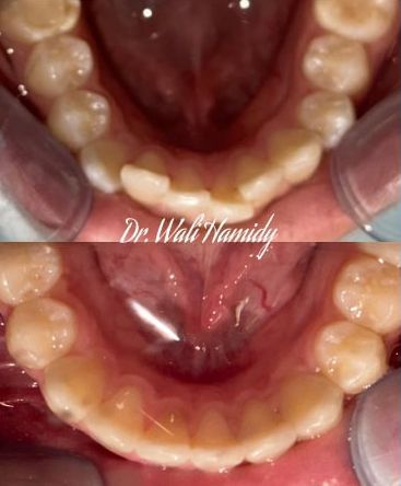 Invisalign Before & Afters