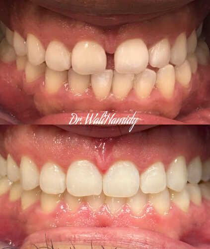 Invisalign Before & Afters