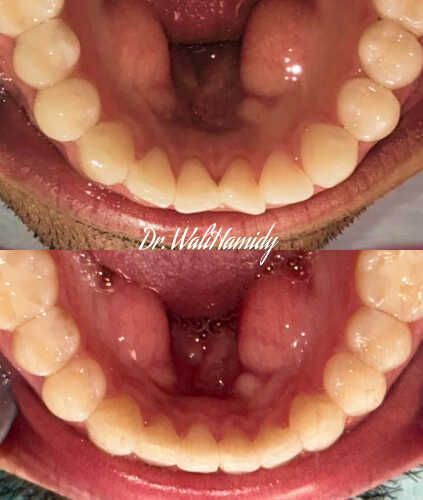 Invisalign Before & Afters