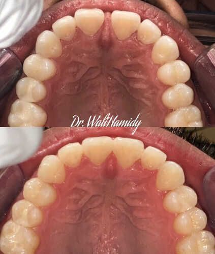 Invisalign Before & Afters