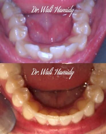 Invisalign Before & Afters